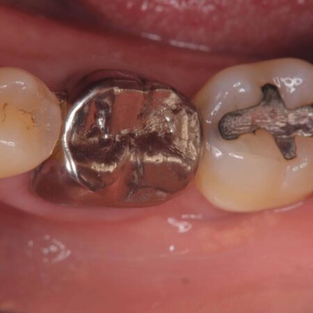 根尖性歯周炎|分岐部病変|パーフォレーション|インプラント治療で改善 治療前