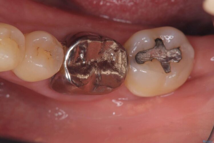 根尖性歯周炎|分岐部病変|パーフォレーション|インプラント治療で改善 ビフォー