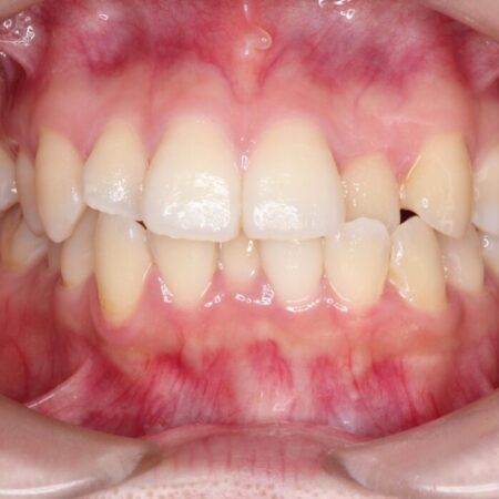 ワイヤー矯正で口元を下げたい、下の歯の凹凸を無くしたい 治療前