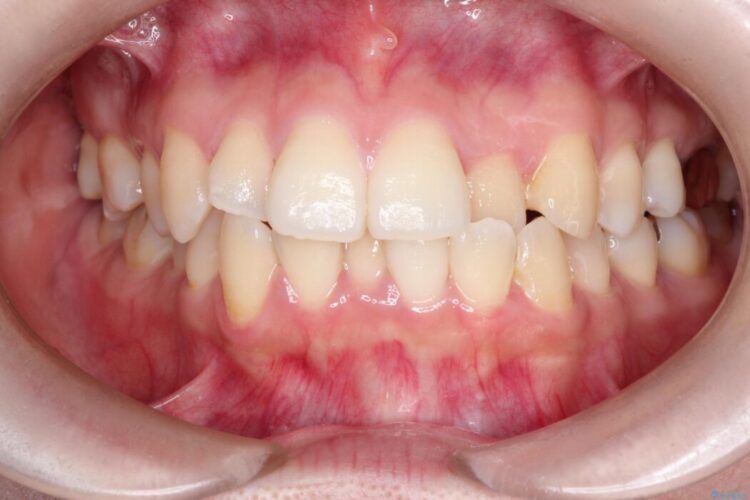 ワイヤー矯正で口元を下げたい、下の歯の凹凸を無くしたい 治療前画像