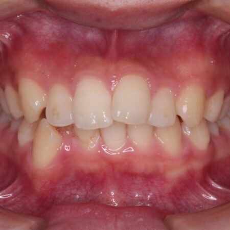 重度の歯のがたつきをインビザラインで改善 治療前