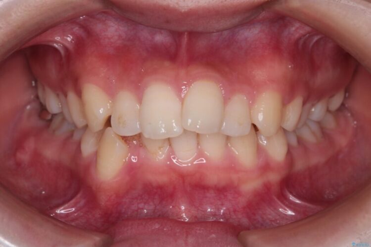 重度の歯のがたつきをインビザラインで改善 治療前画像