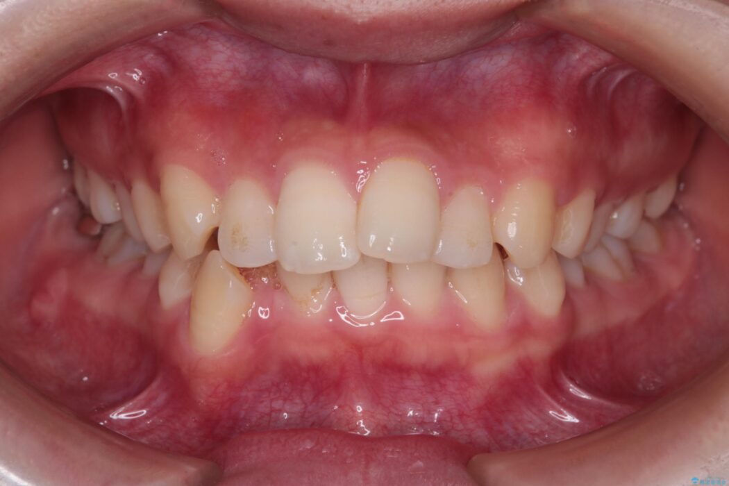 重度の歯のがたつきをインビザラインで改善 治療前