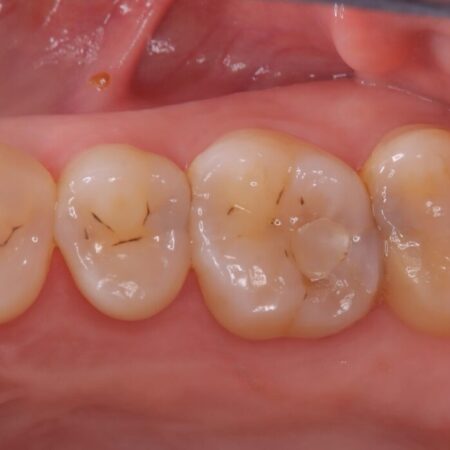 2回の来院で完了！奥歯のセラミック修復 治療前