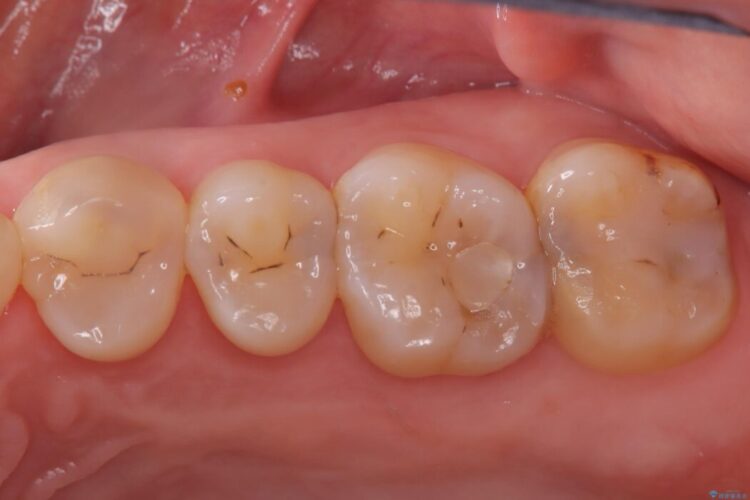 2回の来院で完了！奥歯のセラミック修復 ビフォー