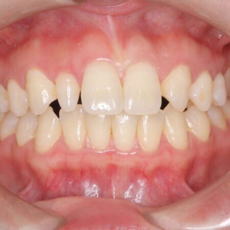 軽度の叢生|わずか5か月の短期間矯正 治療前