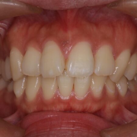 ワイヤー矯正で口元の突出感を改善！横顔を美しく 治療前