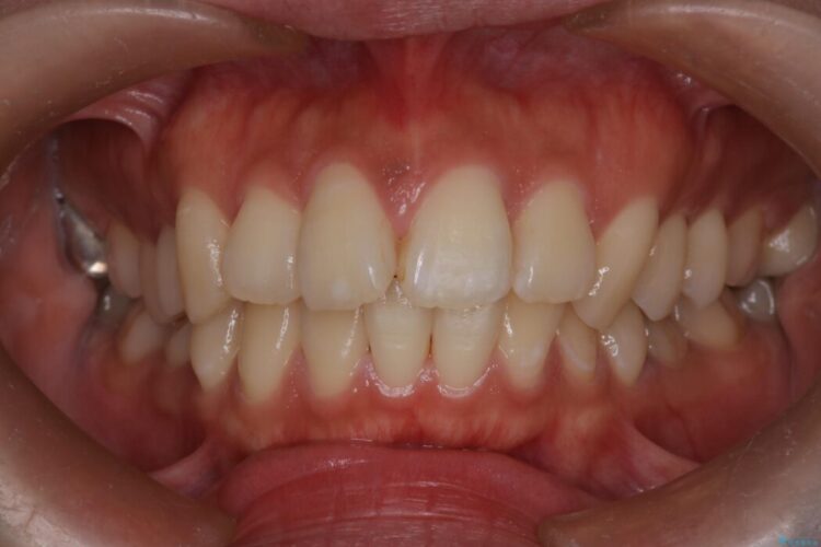 ワイヤー矯正で口元の突出感を改善!横顔を美しく 治療前画像