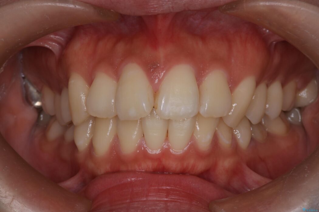 ワイヤー矯正で口元の突出感を改善！横顔を美しく 治療前