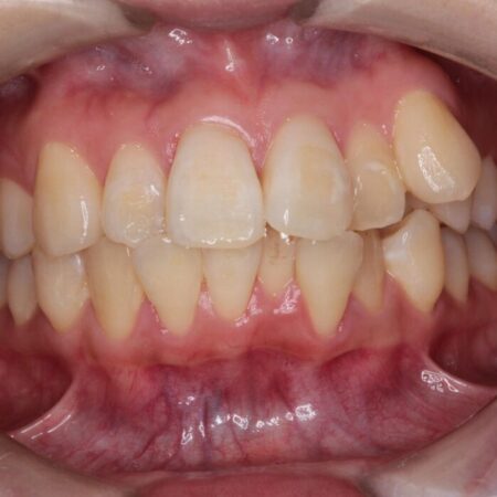 目立ちにくいワイヤー矯正で八重歯と正中のズレを解消 治療前