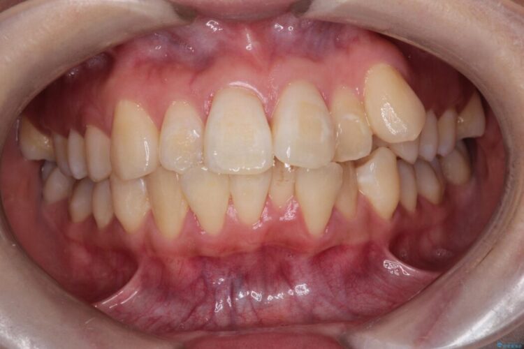 目立ちにくいワイヤー矯正で八重歯と正中のズレを解消 ビフォー