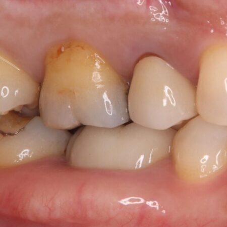 奥歯の銀歯を白い歯に！歯の破折を防ぐセラミッククラウン 治療前