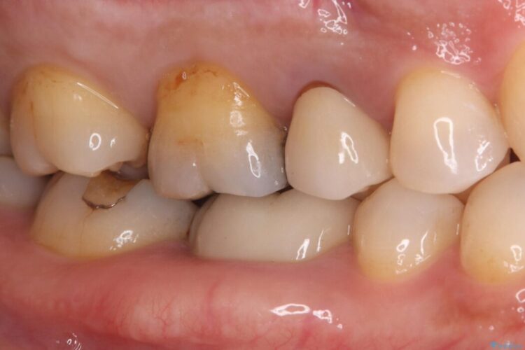 奥歯の銀歯を白い歯に！歯の破折を防ぐセラミッククラウン ビフォー