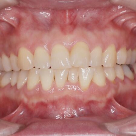 1年で完了！前歯の軽度なガタつきをワイヤー矯正で美しく 治療前