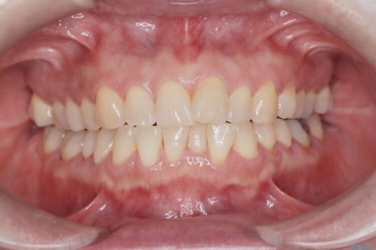 1年で完了！前歯の軽度なガタつきをワイヤー矯正で美しく 治療前画像