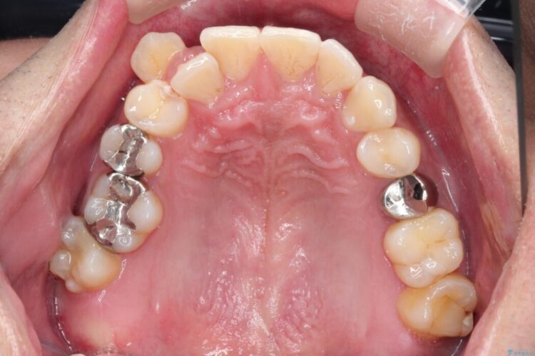 目立つ八重歯と下の歯の凸凹を治したい 治療前画像