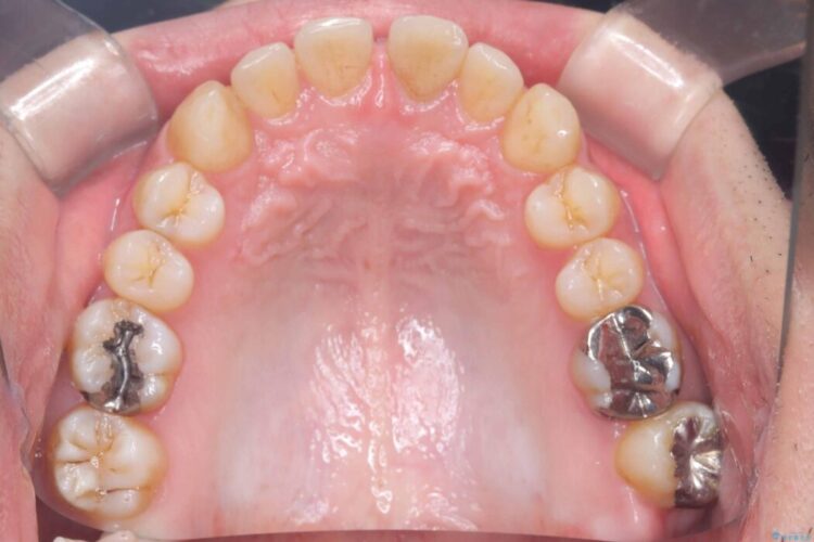 正中離開・クロスバイト・すきっ歯・叢生|インビザラインで改善 治療前画像
