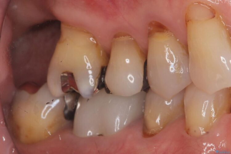 重度歯周病で失った2本の奥歯を1DAYインプラント治療 治療前画像