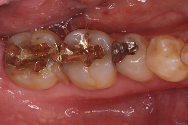 欠けた奥歯をPGAで補強。違和感のない咬み心地へ 治療前画像