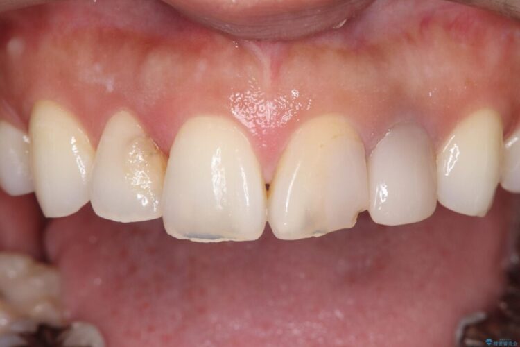 欠けて変色した前歯をオールセラミックで美しく 治療前画像