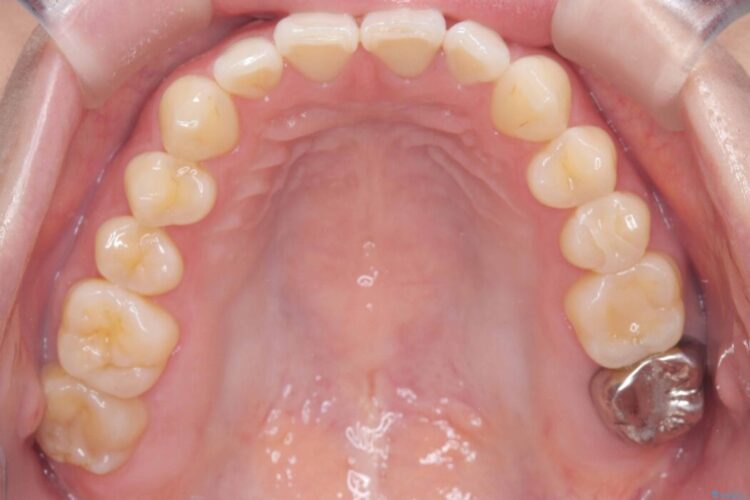 すきっ歯・切端咬合・空隙歯列をインビザラインで短期間矯正 治療前画像