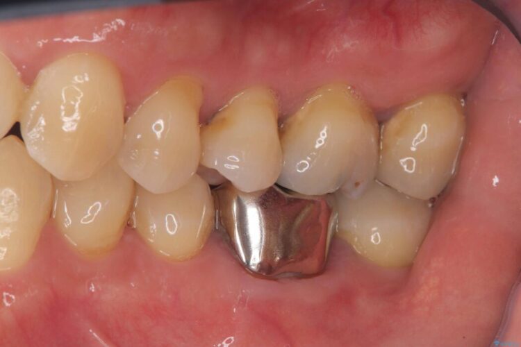根尖性歯周炎|分岐部病変|パーフォレーション|インプラント治療で改善 治療前画像