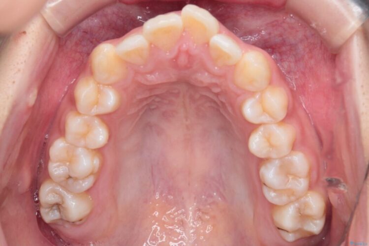 重度の歯のがたつきをインビザラインで改善 治療前画像