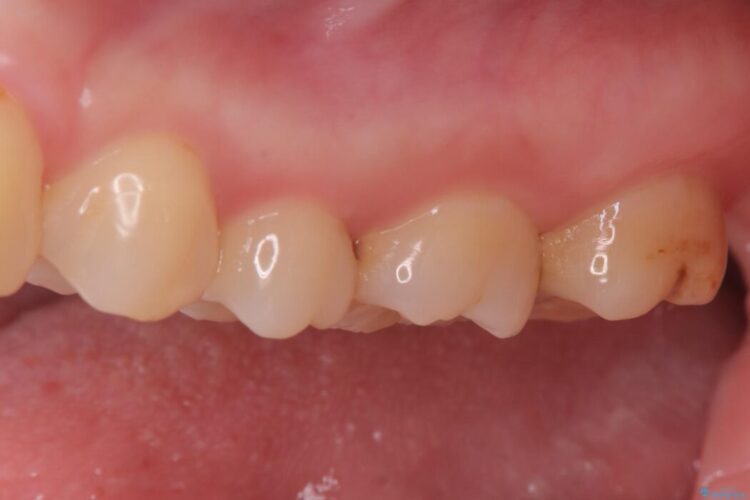 2回の来院で完了！奥歯のセラミック修復 治療前画像