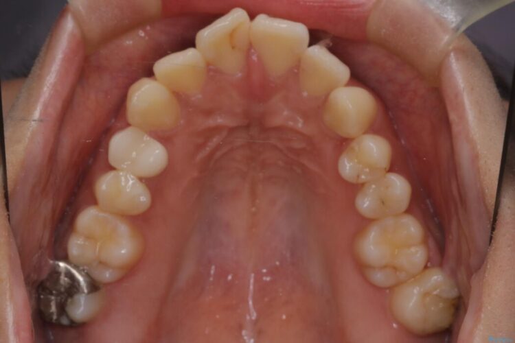 ワイヤー矯正で口元の突出感を改善!横顔を美しく 治療前画像