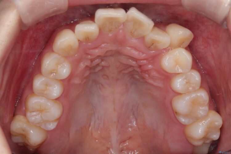 目立ちにくいワイヤー矯正で八重歯と正中のズレを解消 治療前画像
