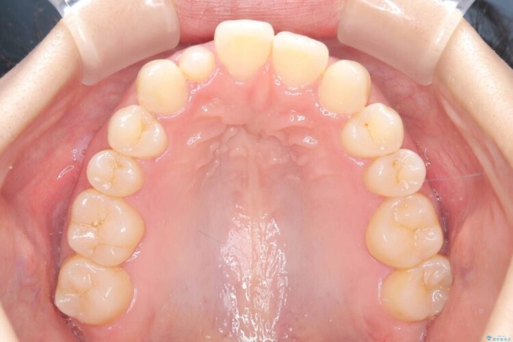 軽度の叢生|わずか5か月の短期間矯正 治療前画像