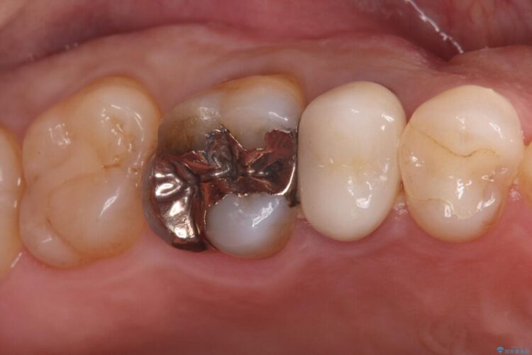 奥歯の銀歯を白い歯に!歯の破折を防ぐセラミッククラウン 治療前画像