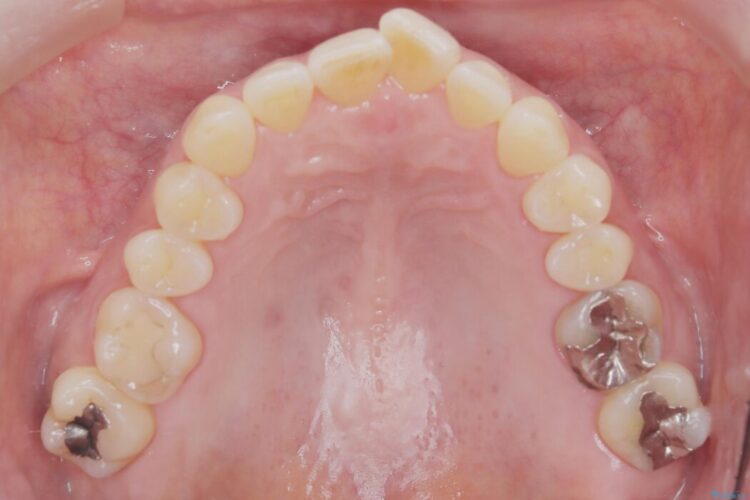 1年で完了！前歯の軽度なガタつきをワイヤー矯正で美しく 治療前画像