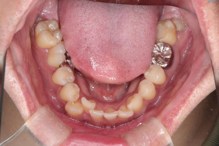 目立つ八重歯と下の歯の凸凹を治したい 治療前画像