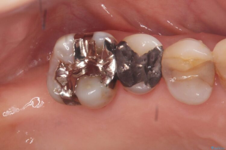 重度歯周病で失った2本の奥歯を1DAYインプラント治療 治療前画像