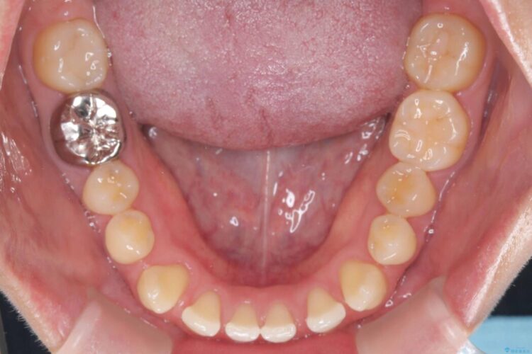 すきっ歯・切端咬合・空隙歯列をインビザラインで短期間矯正 治療前画像