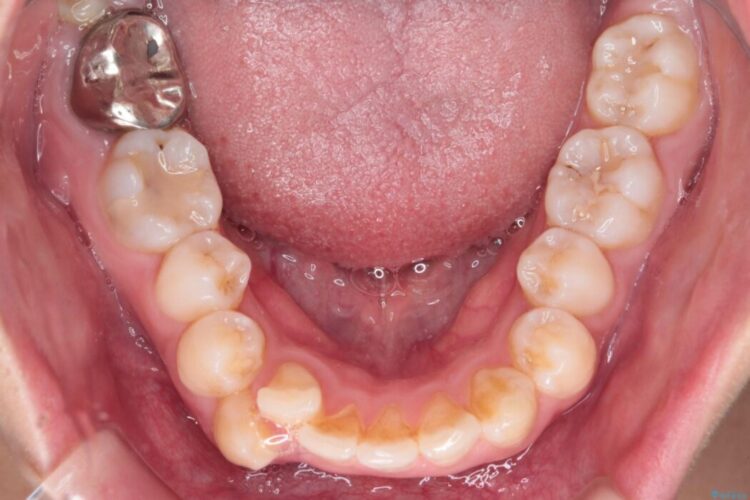 重度の歯のがたつきをインビザラインで改善 治療前画像