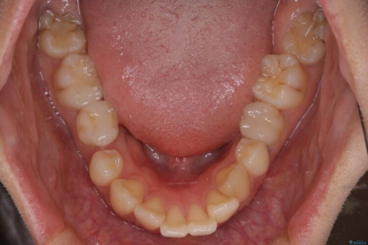 ワイヤー矯正で口元の突出感を改善!横顔を美しく 治療前画像