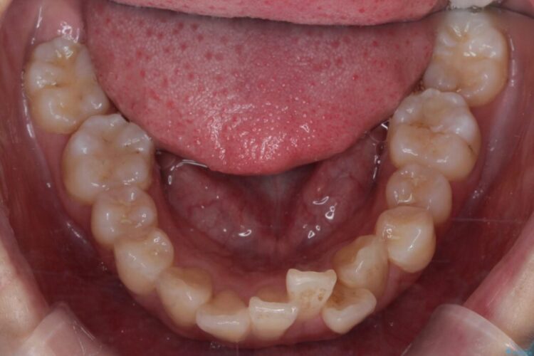 ワイヤー矯正で八重歯と正中のズレを解消 治療前画像