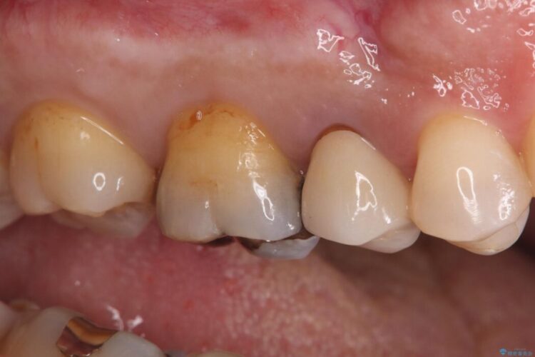 奥歯の銀歯を白い歯に!歯の破折を防ぐセラミッククラウン 治療前画像