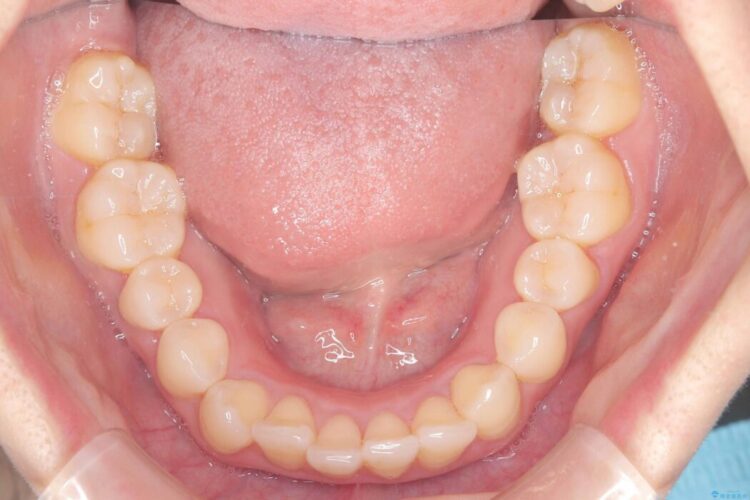 軽度の叢生|わずか5か月の短期間矯正 治療前画像