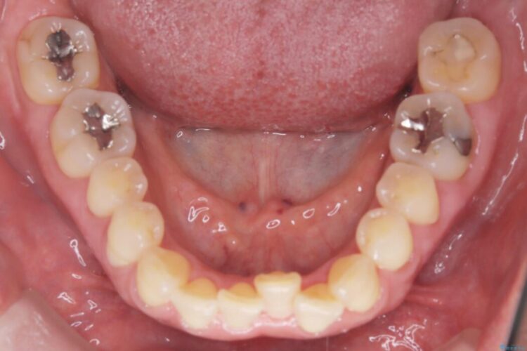 1年で完了！前歯の軽度なガタつきをワイヤー矯正で美しく 治療前画像