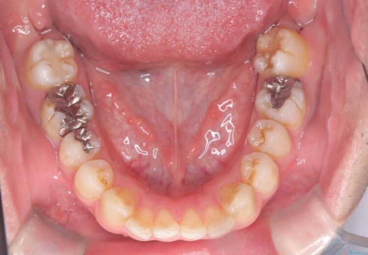 正中離開・クロスバイト・すきっ歯・叢生|インビザラインで改善 治療前画像