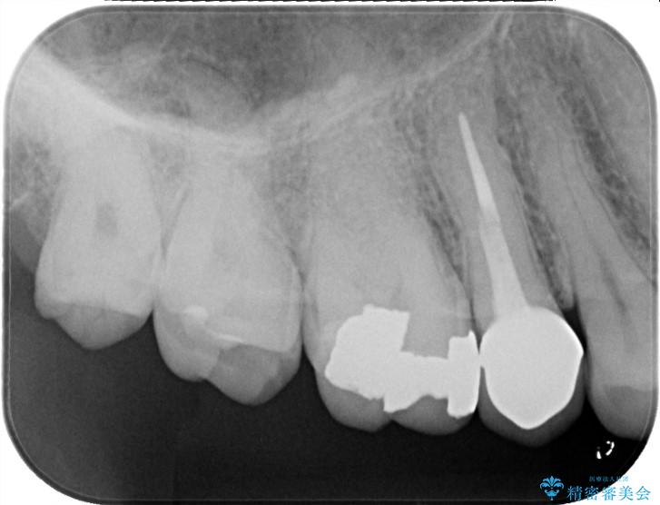 奥歯の銀歯を白い歯に!歯の破折を防ぐセラミッククラウン 治療前画像