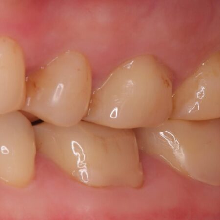 奥歯の痛みを解消！クラウンで長期的に歯を守る 治療前