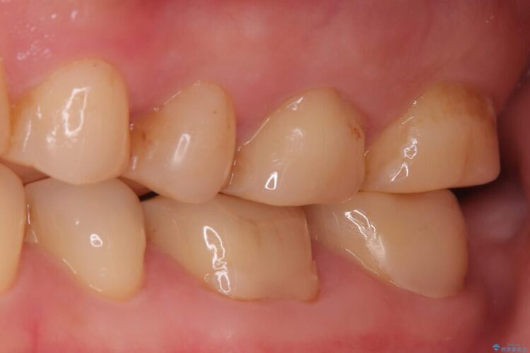 奥歯の痛みを解消！クラウンで長期的に歯を守る ビフォー