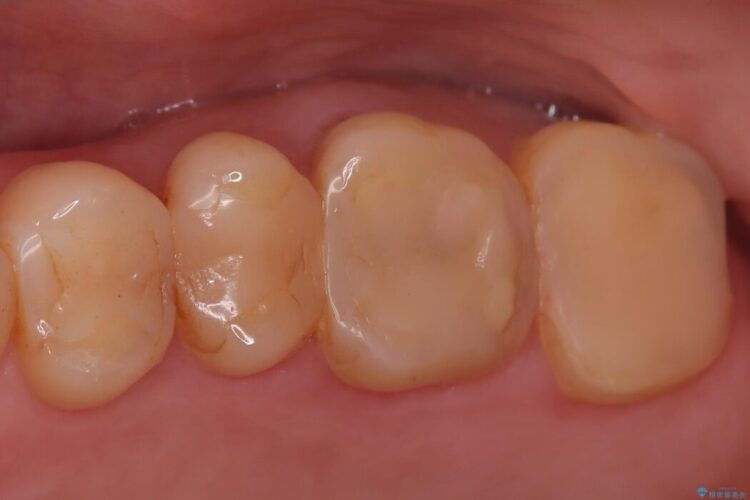 奥歯の痛みを解消!クラウンで長期的に歯を守る 治療前画像