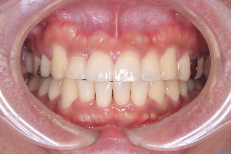 目立つ八重歯と下の歯の凸凹を治したい アフター