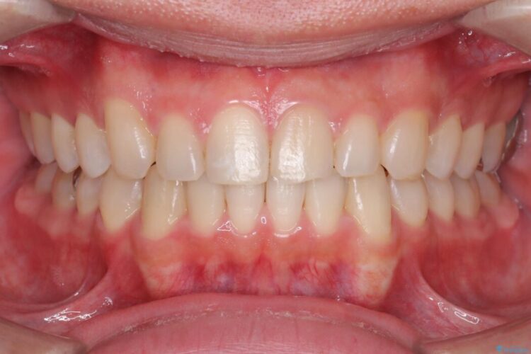 正中離開・クロスバイト・すきっ歯・叢生|インビザラインで改善 治療後画像