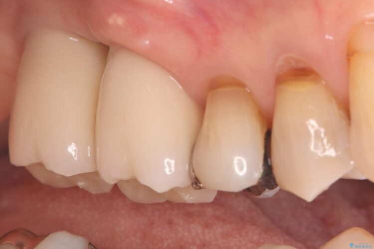 重度歯周病で失った2本の奥歯を1DAYインプラント治療 治療後画像